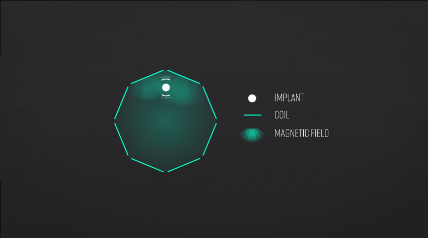 Diagram showing implant, coil, and magnetic field with labeled elements and demonstrating wireless energy transfer or inductive charging concept.